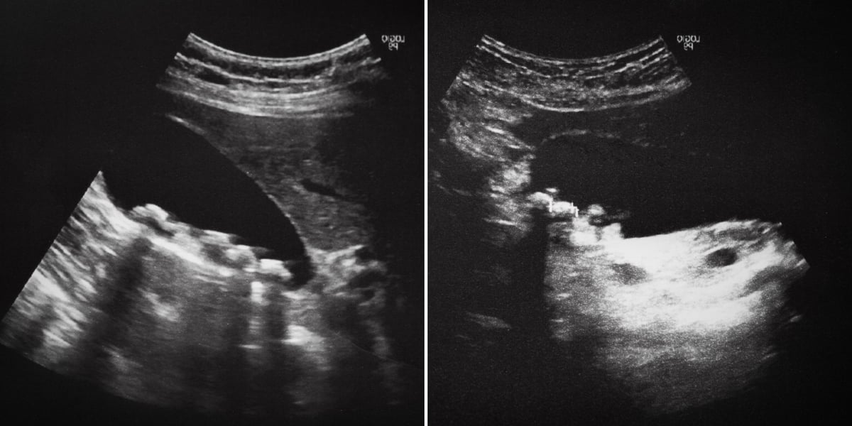 A gallstone is a stone formed within the gallbladder. Medical ultrasound diagnostic examination of the gallbladder showing gallstones and polyps.